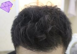 -大麦微针植发丨全国连锁