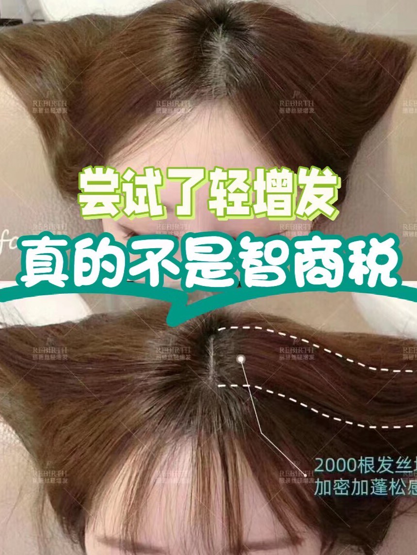 不吃药植发增发(不吃药不植发的物理增发)