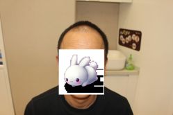 -大麦微针植发丨全国连锁