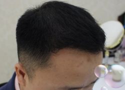 -大麦微针植发丨全国连锁