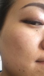 -北京美痣堂古方祛痣斑疣瘊