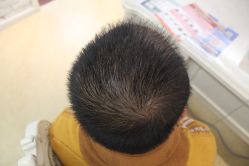 点击看大图 -大麦微针植发丨全国连锁