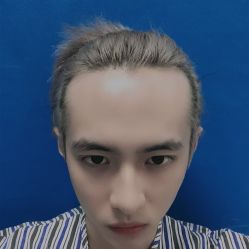 -碧莲盛·不剃发植发