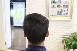 点击看大图 -大麦微针植发丨全国连锁