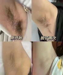 -薇兰专业脱毛连锁机构