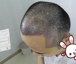 -大麦微针植发丨全国连锁