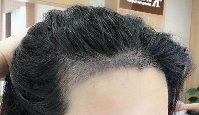 -大麦微针植发丨全国连锁