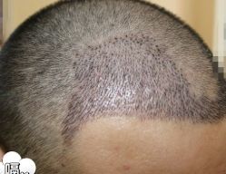 -大麦微针植发丨全国连锁