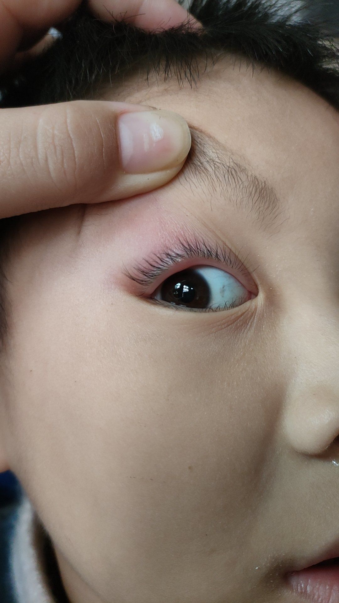 眼睛上长了个脓包怎么办?很疼,都肿了