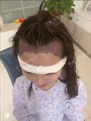 点击看大图 -大麦微针植发丨全国连锁