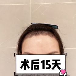 -碧莲盛·不剃发植发