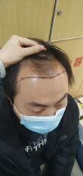 -大麦微针植发丨全国连锁