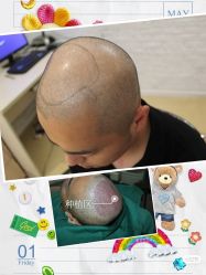 -大麦微针植发全国连锁