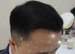-大麦微针植发全国连锁