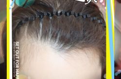 -大麦微针植发全国连锁