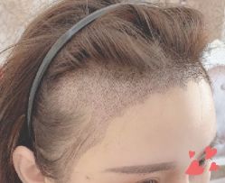 -大麦微针植发丨全国连锁