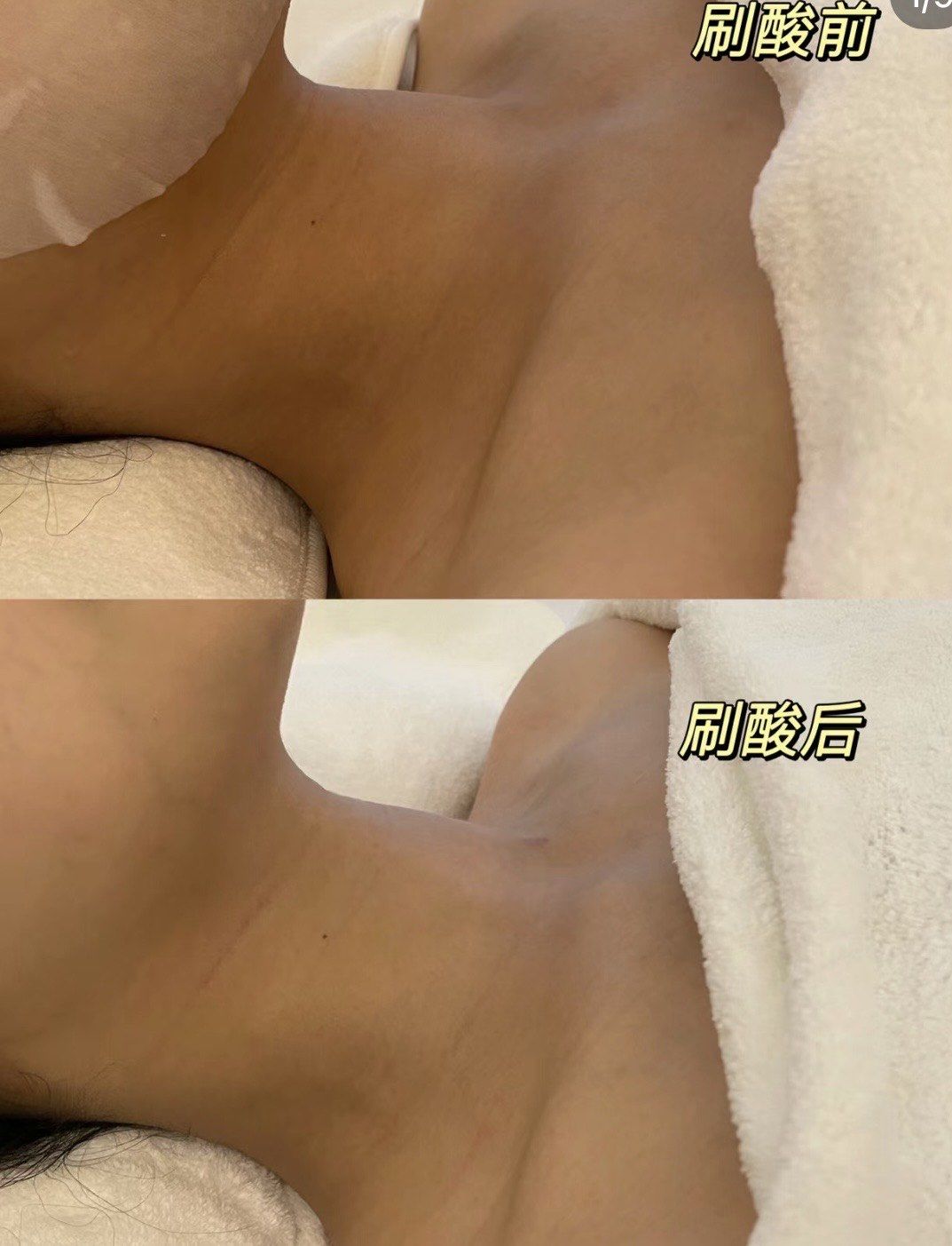 必刷的酸 法式牛奶焕肤