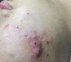 -瑶芳清颜草本祛痘