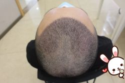 -大麦微针植发丨全国连锁