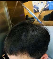 -碧莲盛·不剃发植发