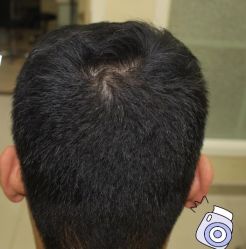 -大麦微针植发丨全国连锁