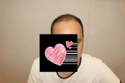 -大麦微针植发丨全国连锁