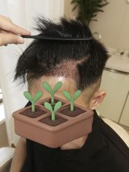 -大麦微针植发全国连锁