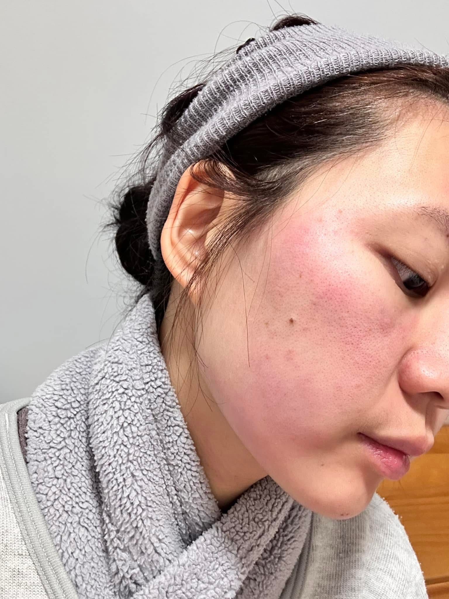 脸部过敏怎么办,有负离子面罩来帮助