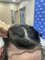 -碧莲盛不剃发植发