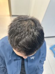 -大麦微针植发全国连锁