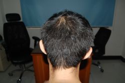 -大麦微针植发丨全国连锁