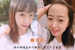 -大麦微针植发丨全国连锁