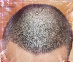 -大麦微针植发全国连锁