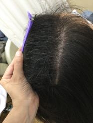 -菩叶脱发白发中心