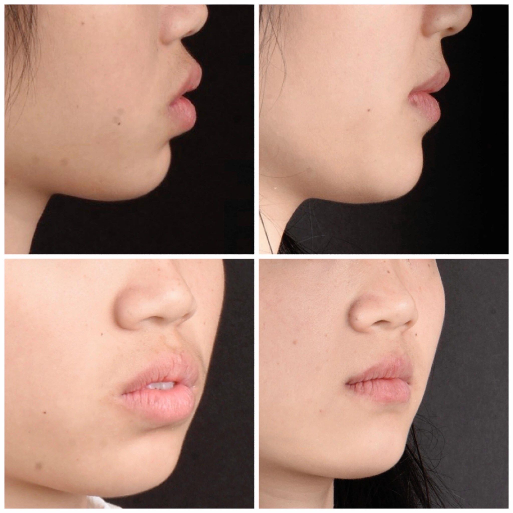 牙齿矫正前后对比