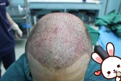 点击看大图 -大麦微针植发丨全国连锁