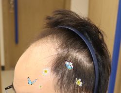 -大麦微针植发全国连锁