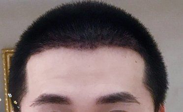 -大麦微针植发丨全国连锁