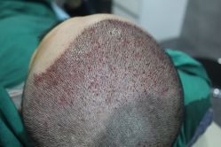 点击看大图 -大麦微针植发丨全国连锁