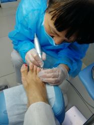 -派恩宜灰指甲鸡眼嵌甲手足癣