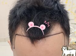 -大麦微针植发全国连锁