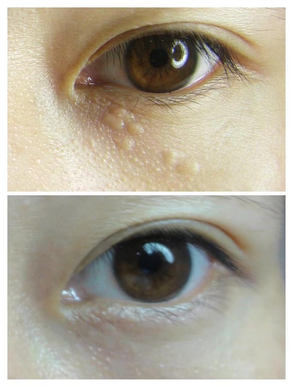 "告别汗管瘤烦恼,靓点伊佳美容院有妙招"