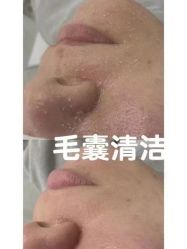 -瑶芳清颜草本祛痘