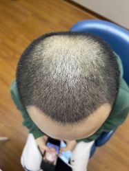 体验后-大麦微针植发全国连锁