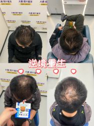 -大麦微针植发全国连锁