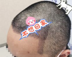 -大麦微针植发全国连锁