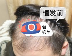 -大麦微针植发全国连锁