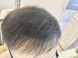-碧莲盛·不剃发植发