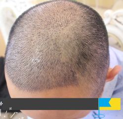 -大麦微针植发丨全国连锁