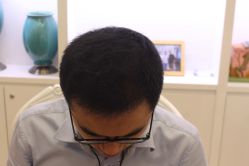 点击看大图 -大麦微针植发丨全国连锁